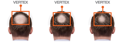 Three views of a person's head showing hair density at the vertex area.
