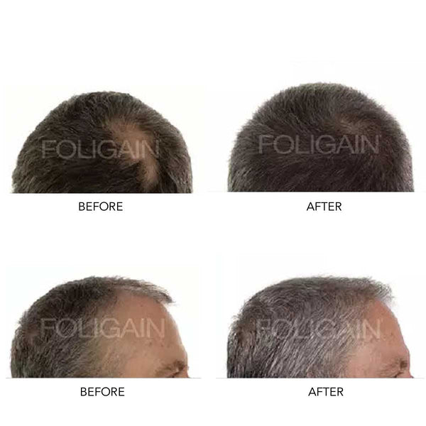 FOLIGAIN Men's Hair Regrowth Kit - FOLIGAIN JAPAN
