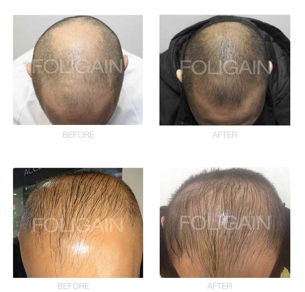 FOLIGAIN Minoxidil 5% Hair Regrowth Treatment For Men 3 Month Supply - FOLIGAIN JAPAN