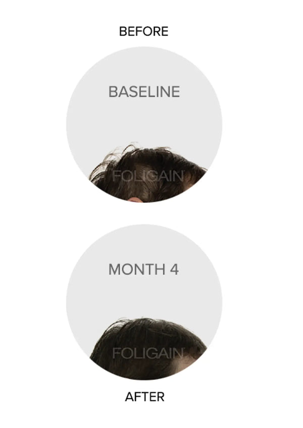 FOLIGAIN Triple Action Complete Formula For Thinning Hair For Women with 10% Trioxidil - FOLIGAIN JAPAN