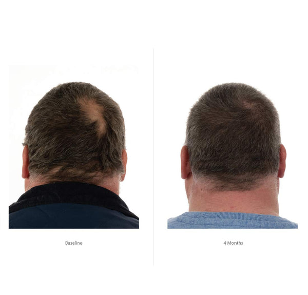 FOLIGAIN Advanced Hair Regrowth Hair Shampoo Minoxidil 2% - FOLIGAIN JAPAN