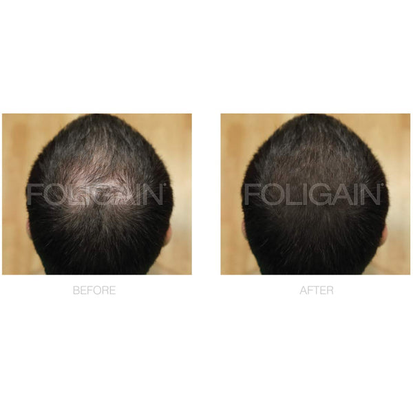 FOLIGAIN Minoxidil 5% Hair Regrowth Treatment For Men 3 Month Supply - FOLIGAIN JAPAN