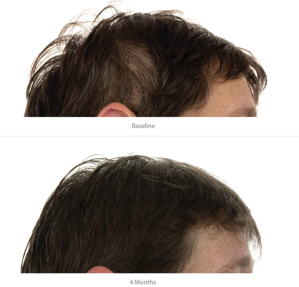 FOLIGAIN Advanced Hair Regrowth Hair Shampoo Minoxidil 2% - FOLIGAIN JAPAN