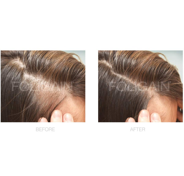 FOLIGAIN Minoxidil 2% Hair Regrowth Treatment For Women 3 Month Supply - FOLIGAIN JAPAN