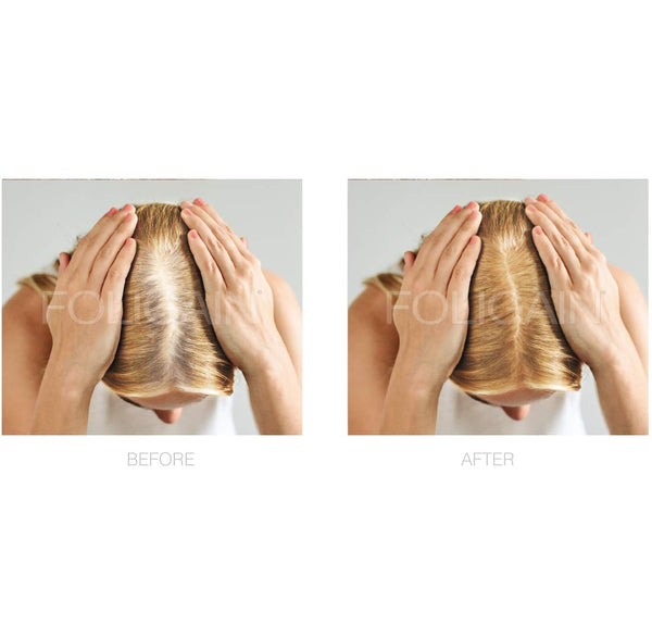 Before and after comparison of a hair transplant on a person's head.
